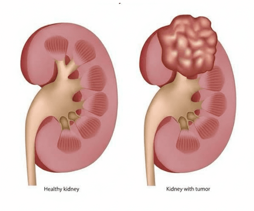 Kidney Cancer Treatment